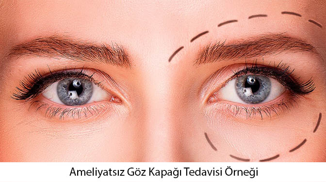 Ameliyatsız Göz Kapağı Estetiği Tedavisi