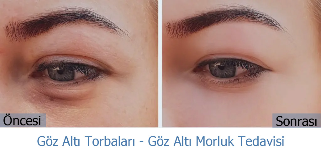 Göz Altı Torba Tedavisi Öncesi ve Sonrası