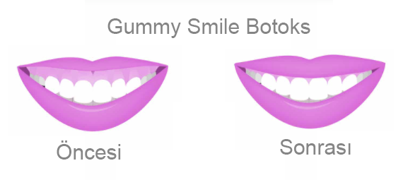 Gummy Smile Botoks