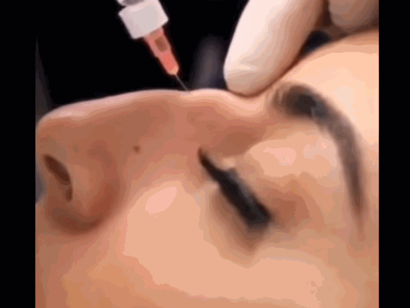 How is Nose Filling Made?