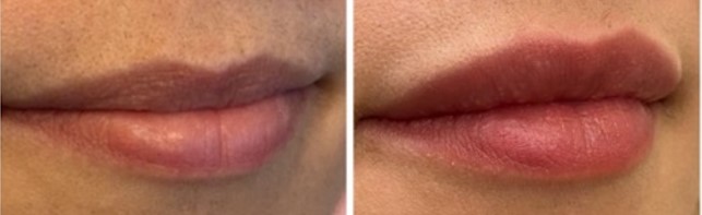 Russian What is the technique of lip fillers