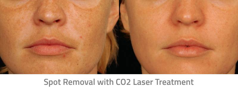 Spot Removal with CO2 Laser Treatment